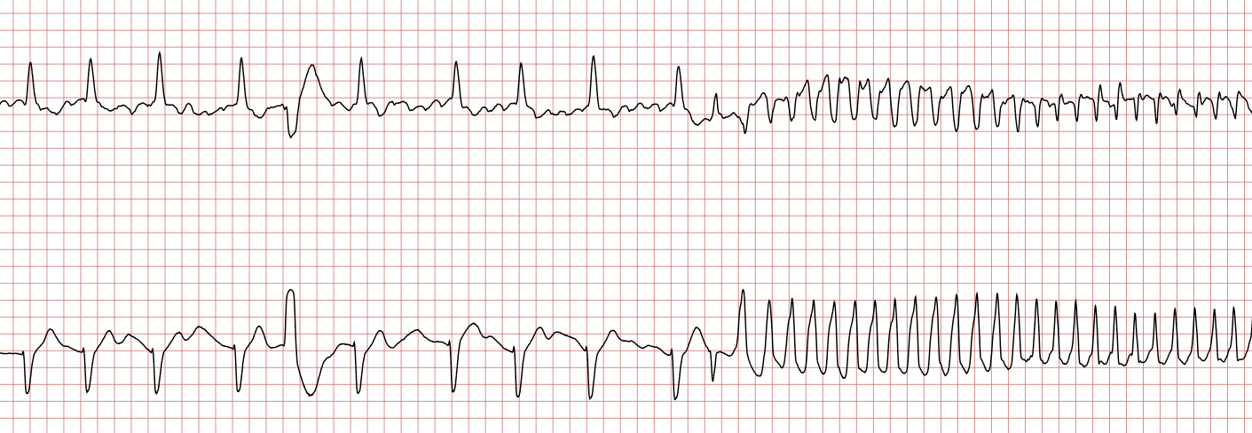 Sudden Cardiac Arrest: Management & Algorithms