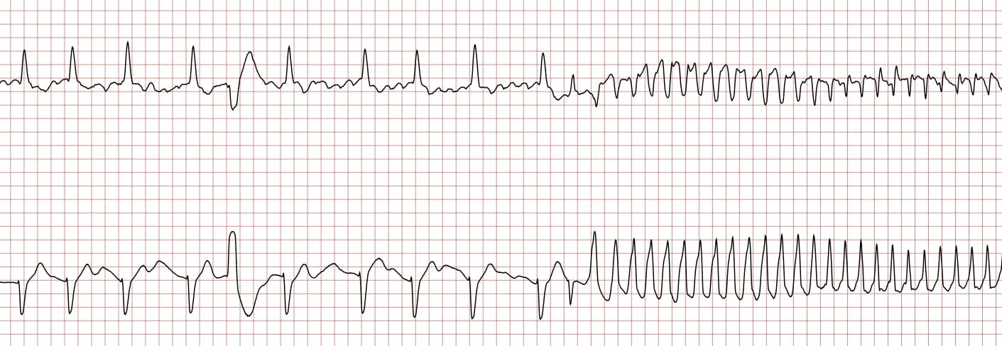 Sudden Cardiac Arrest: Management & Algorithms