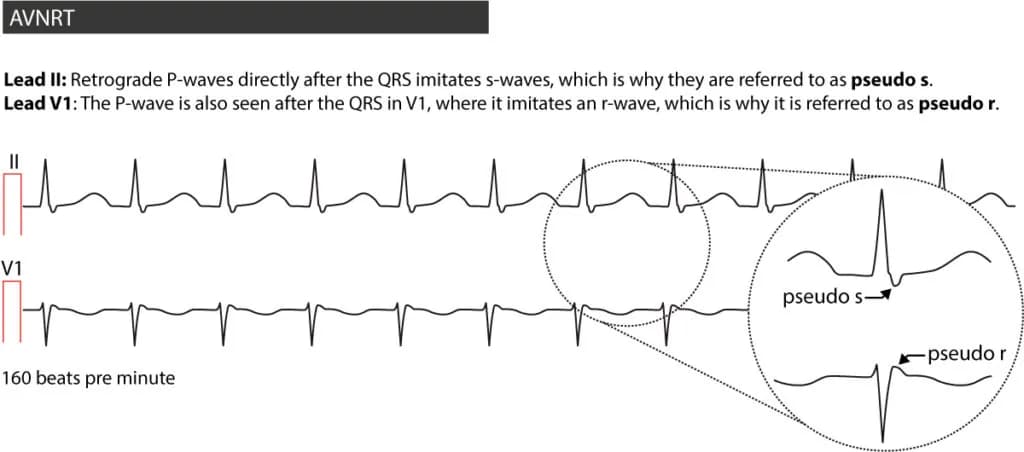 Figure 3. AVNRT in a 20-year old male suffering from palpitations.