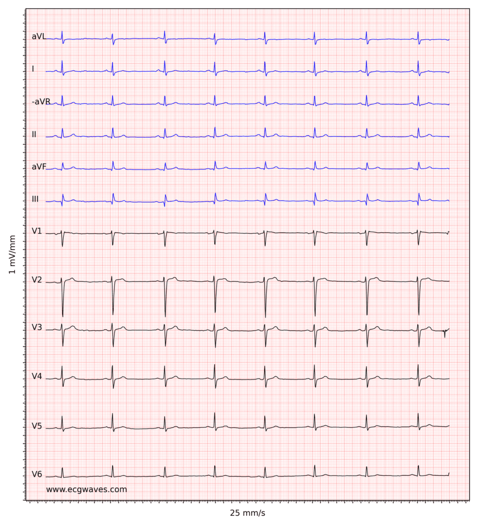 Figure 3. Sinus bradycardia. The small q-waves in inferior leads (II, aVF, III) are not significant. Low voltage in limb leads.