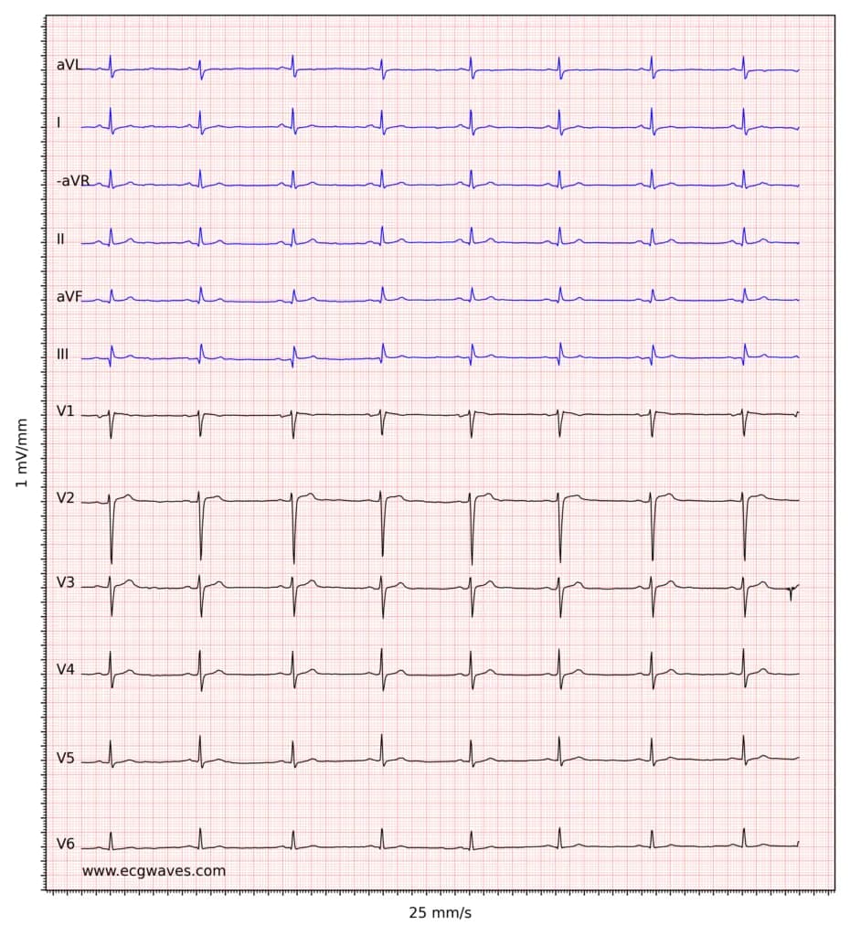 Figure 3. Sinus bradycardia. The small q-waves in inferior leads (II, aVF, III) are not significant. Low voltage in limb leads.