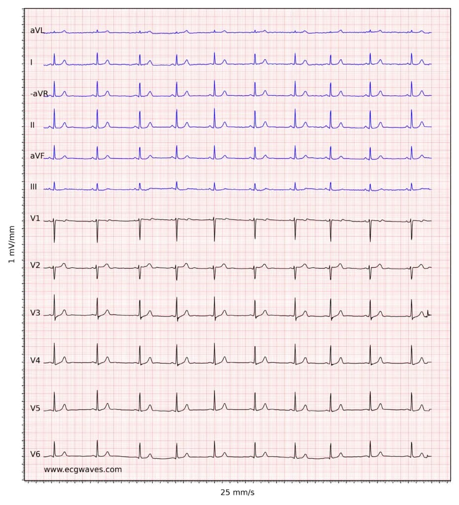 ECG example 3. Normal sinus rhythm.