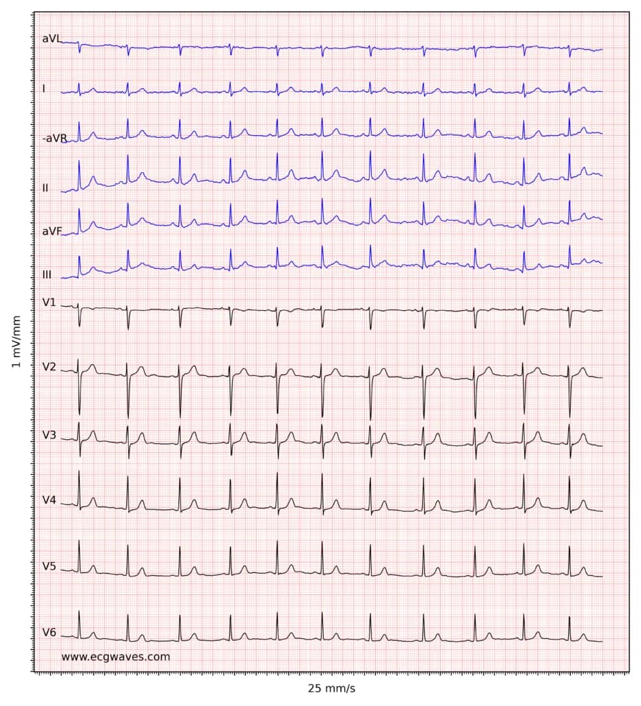 ECG example 4. Normal sinus rhythm.