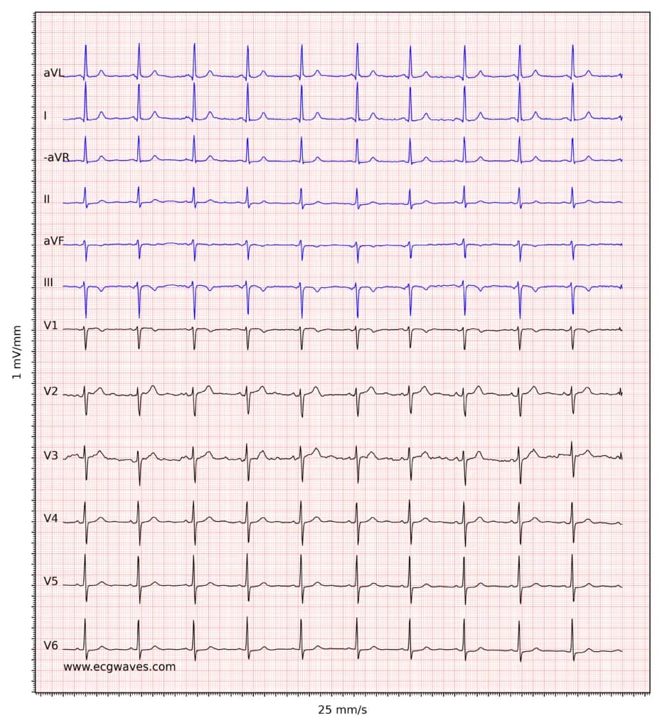 ECG example 5. Sinus rhythm. Negative T-waves in leads aVF and III. Discrete ST-segment depressions in leads V5-V6.