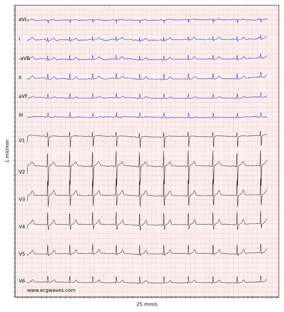 ECG example 6. Sinus rhythm, rapid progression of R-waves in precordial leads. Slight ST-segment elevation in leads V2-V3, which is normal in men and women.