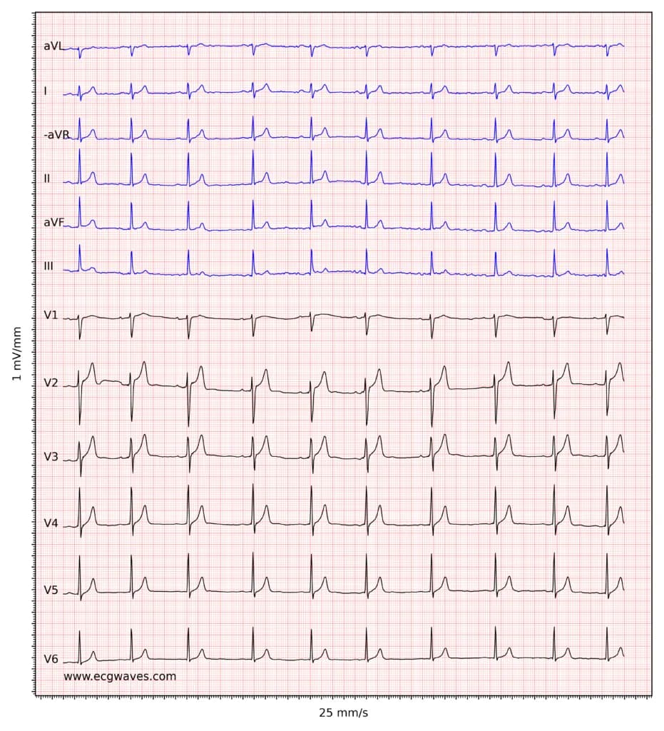 ECG example 7. Sinus rhythm. Relatively large T-waves in V2-V3, with ST-segment elevations. Relative to the R-waves, T-waves are too large and pointed (differential diagnoses are considered below).