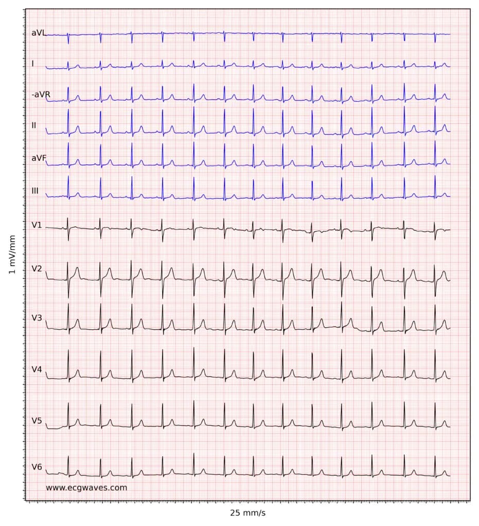 ECG example 1. Normal sinus rhythm.