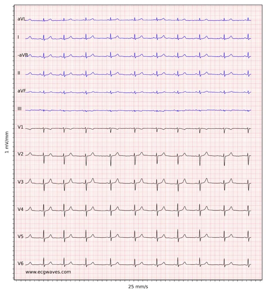ECG example 2. Normal sinus rhythm. R-waves have low amplitude, suggesting low voltage (see below).
