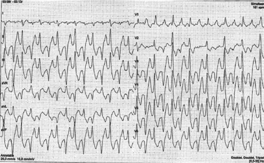 Figure 1. Bidirectional ventricular tachycardia. Source: