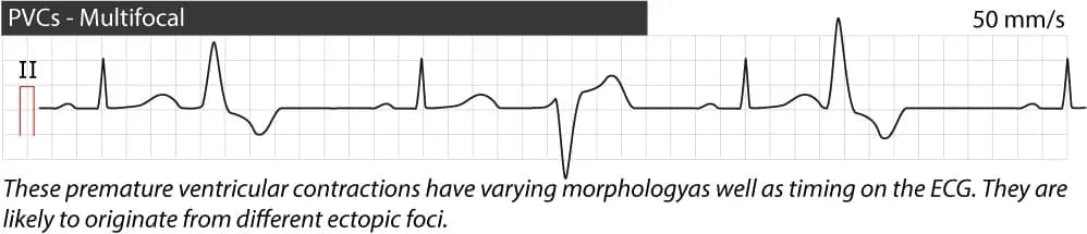 Figure 5. Multifocal premature ventricular contractions.