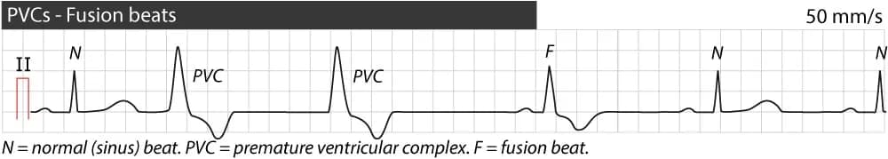 Figure 6. Fusion beat.
