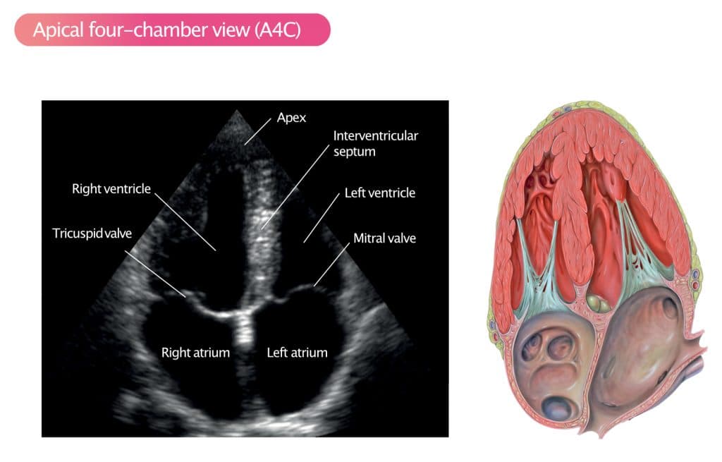 Figure 12. Apical four-chamber view (A4C).