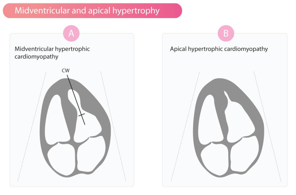 Figure 4. Apical and midventricular hypertrophic cardiomyopathy.