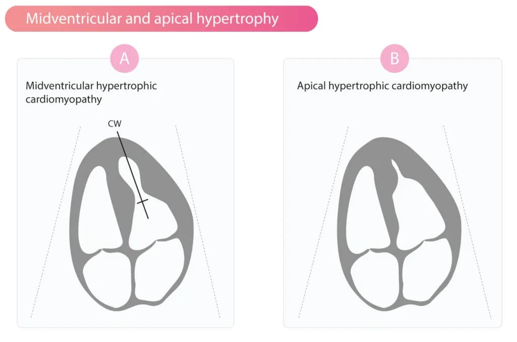 Figure 4. Apical and midventricular hypertrophic cardiomyopathy.