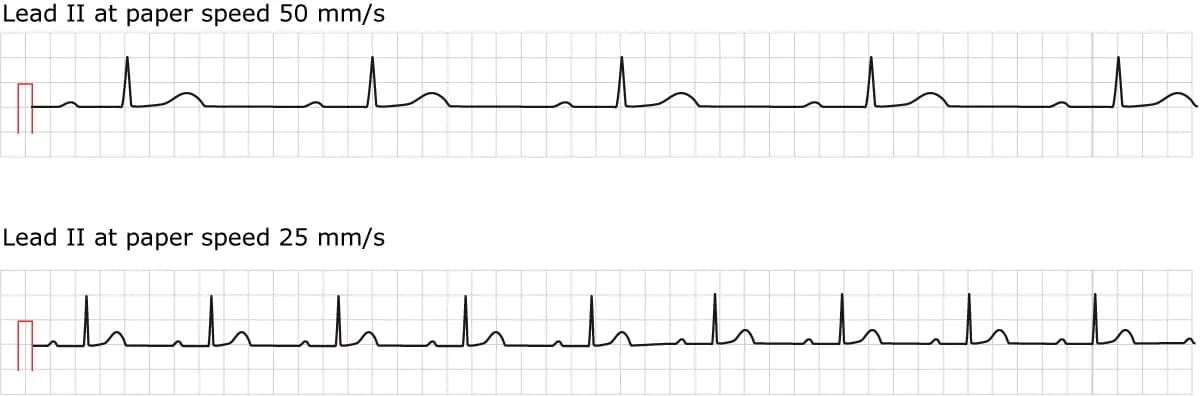 Figure 1. ECG in first-degree AV block. Both conventional paper speeds are shown.