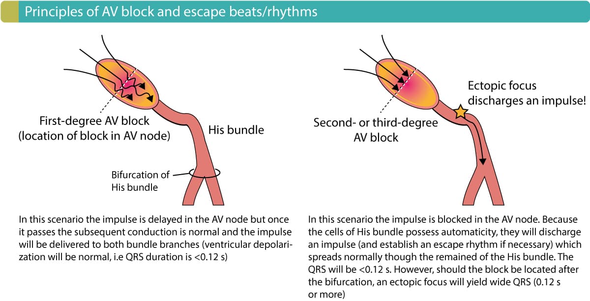 Figure 2. Principles of AV blocks and the emergence of escape rhythms / beats.