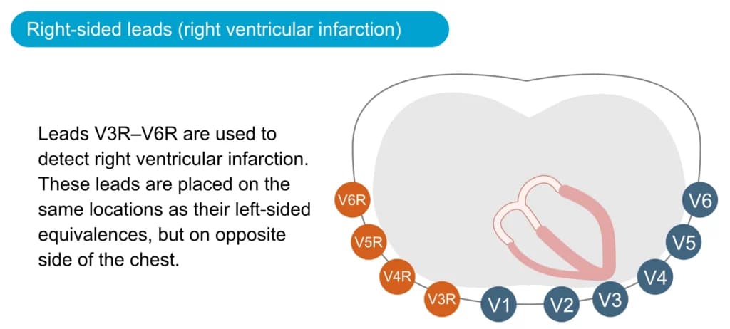 Figure 22. Right-sided chest leads are used if there is suspicion of right ventricular infarction.