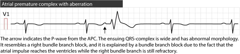 Figure 3. Atrial premature beat conducted with right bundle branch block.