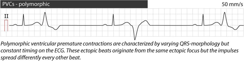 Figure 4. Polymorphic premature ventricular complexes (contractions).