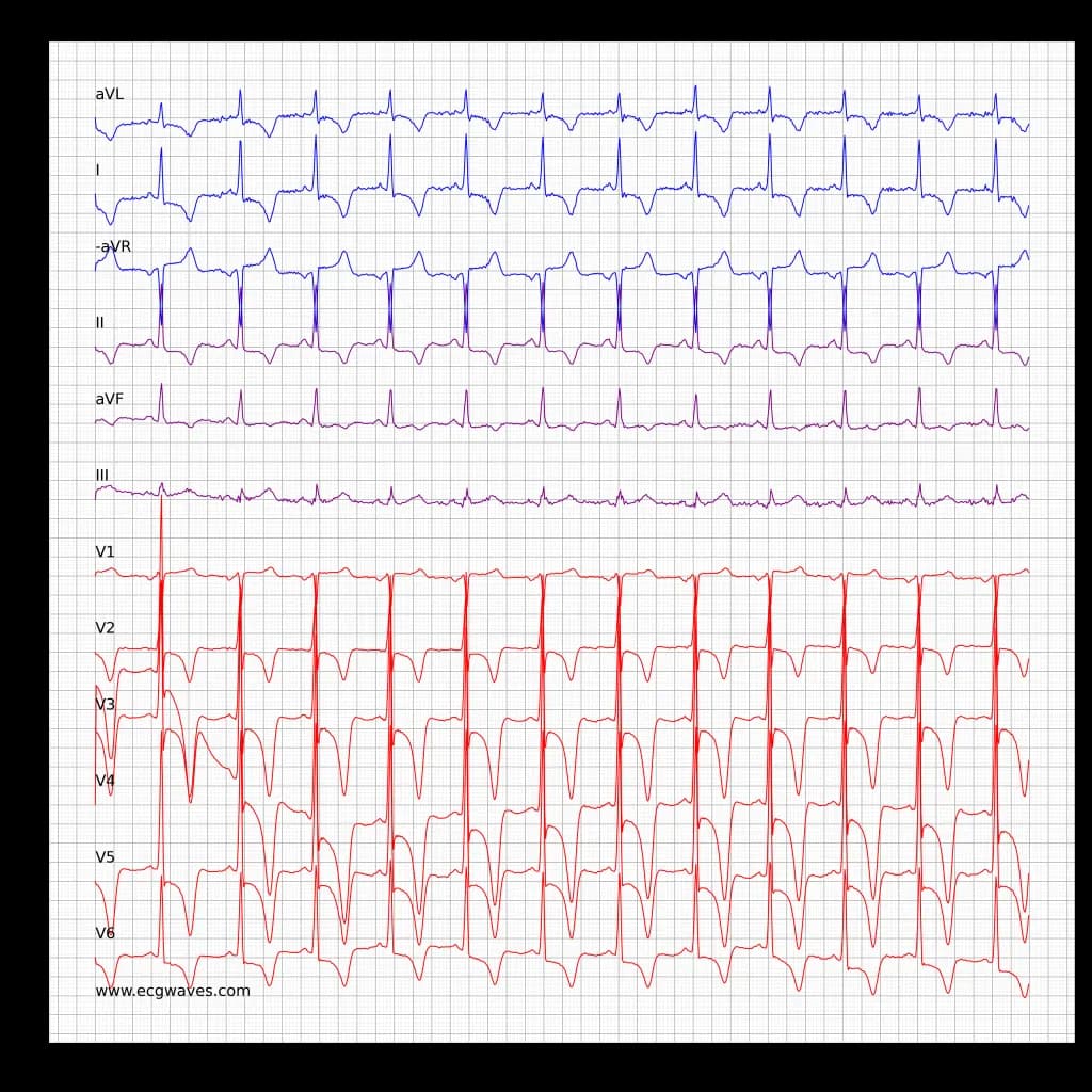 ECG in hypertrophic obstructive cardiomyopathy (HCM, HOCM)
