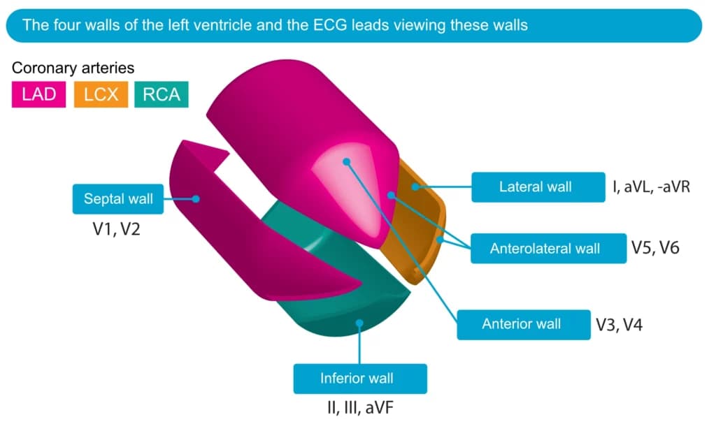 Figure 20. The 12-lead ECG primarily records the electrical activity of the left ventricle (right ventricular electrical activity is less prominent under normal circumstances). As depicted in the figure, the left ventricle has the shape of a bullet. The left ventricle is traditionally divided into four walls (septal wall, lateral wall, inferior wall and anterior wall).