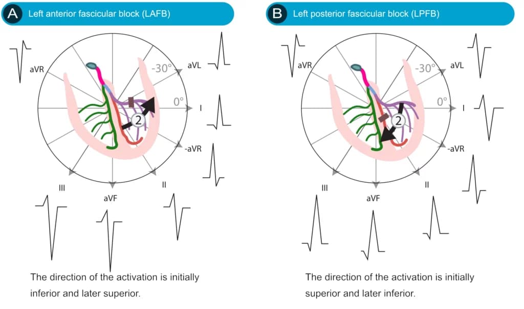 Left anterior fascicular block (anterior hemiblock) and left posterior fascicular block (posterior hemiblock).