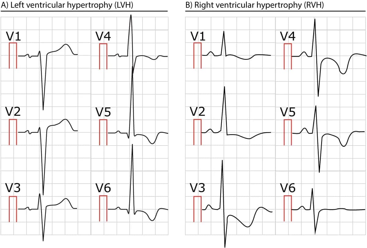 Figure 2. Two ECGs showing left and right ventricular hypertrophy.
