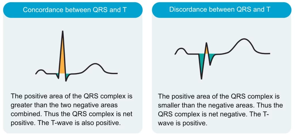 Figure 8. Concordant and discordant T-waves.