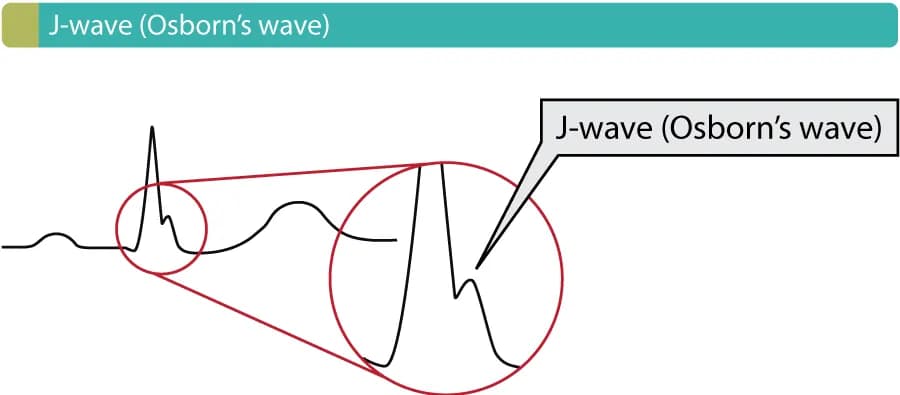 Figure 1. Osborn wave (J wave). These waves occur due to hypothermia, hypercalcemia, early repolarization and Brugada syndrome.