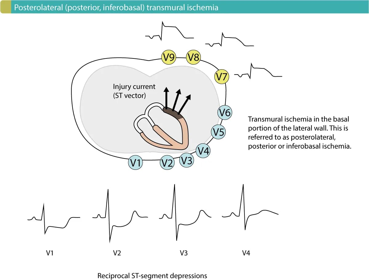 Figure 1. Posterolateral (posterior, inferobasal) transmural ischemia causes reciprocal ST-segment depressions in V1–V3 (ocasionally V4). Leads V7–V9 must be placed to reveal the ST-segment elevations.