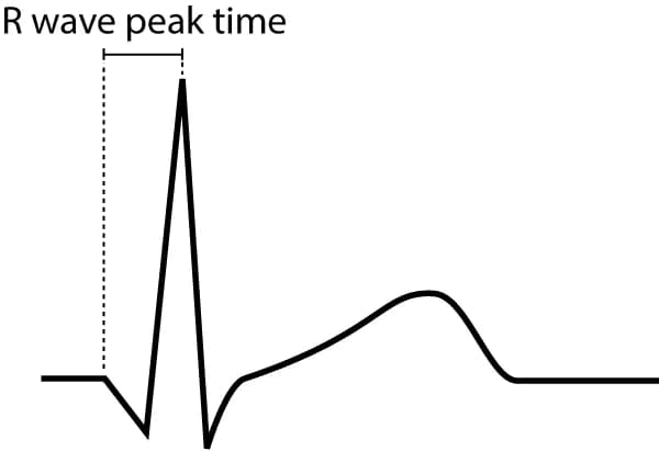 Figure 9. R-wave peak time is defined as the time interval between onset of the QRS complex to the apex of the R-wave.