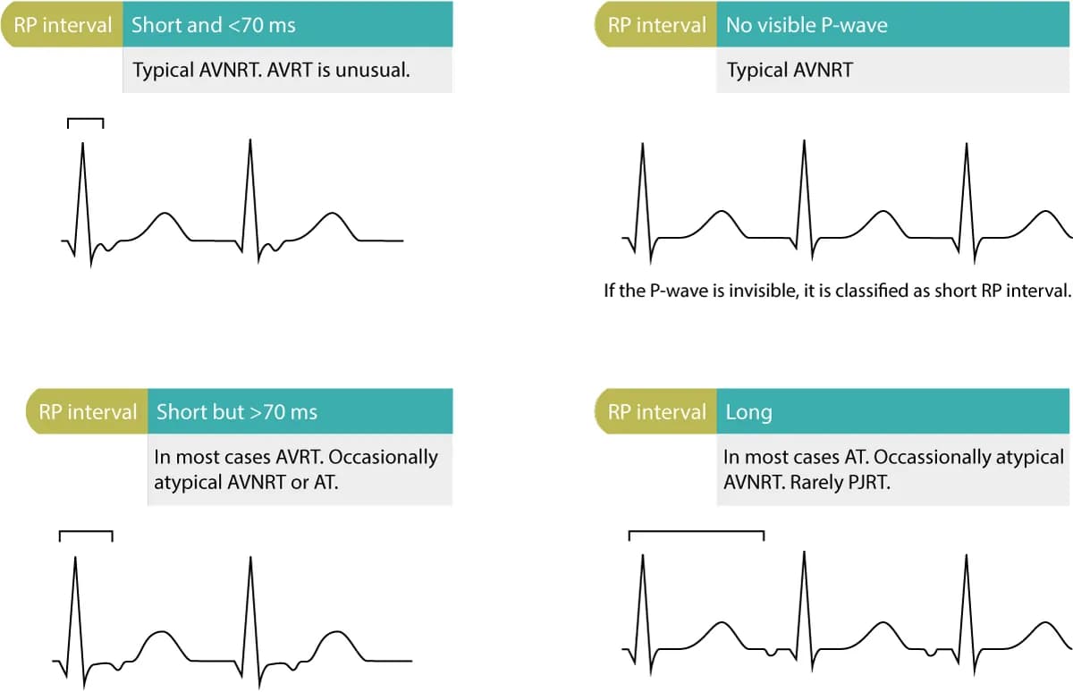 Figure 2. Differential diagnoses based on RP interval.