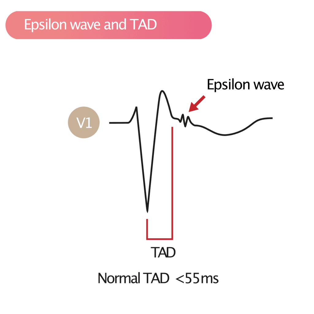 Figure 1. Epsilon wave and TAD on the electrocardiogram.