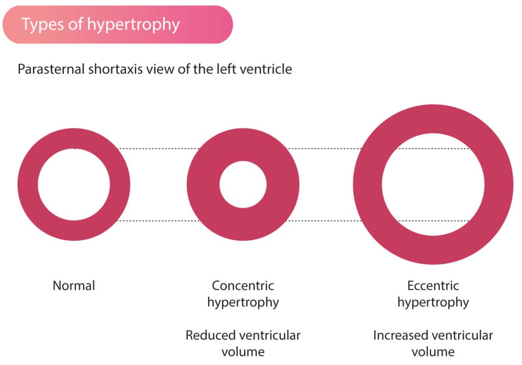 Figure 1. Types of left ventricular hypertrophy. Left ventricular volume is reduced in concentric hypertrophy. Eccentric hypertrophy results in increased ventricular volume.