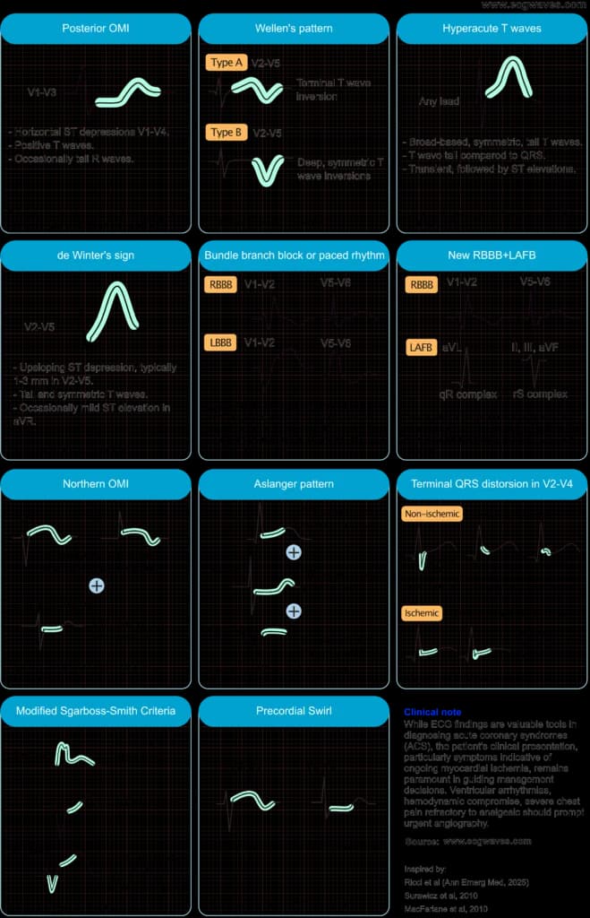Figure 1. ECG patterns suggestive of acute coronary occlusion (ACO).