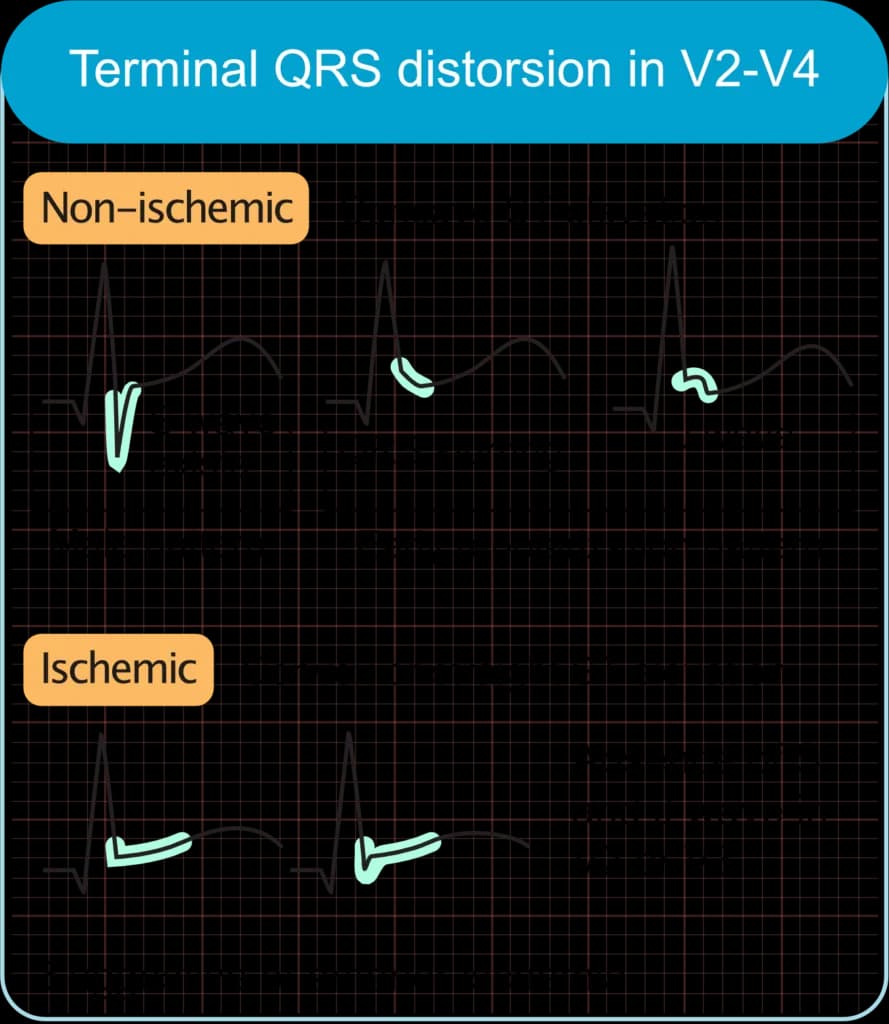 Terminal QRS Distortion