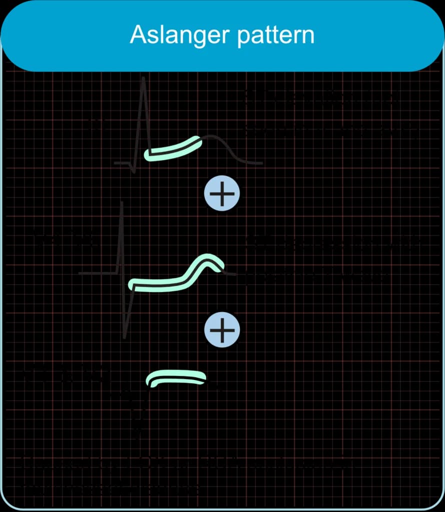 Aslanger ECG pattern