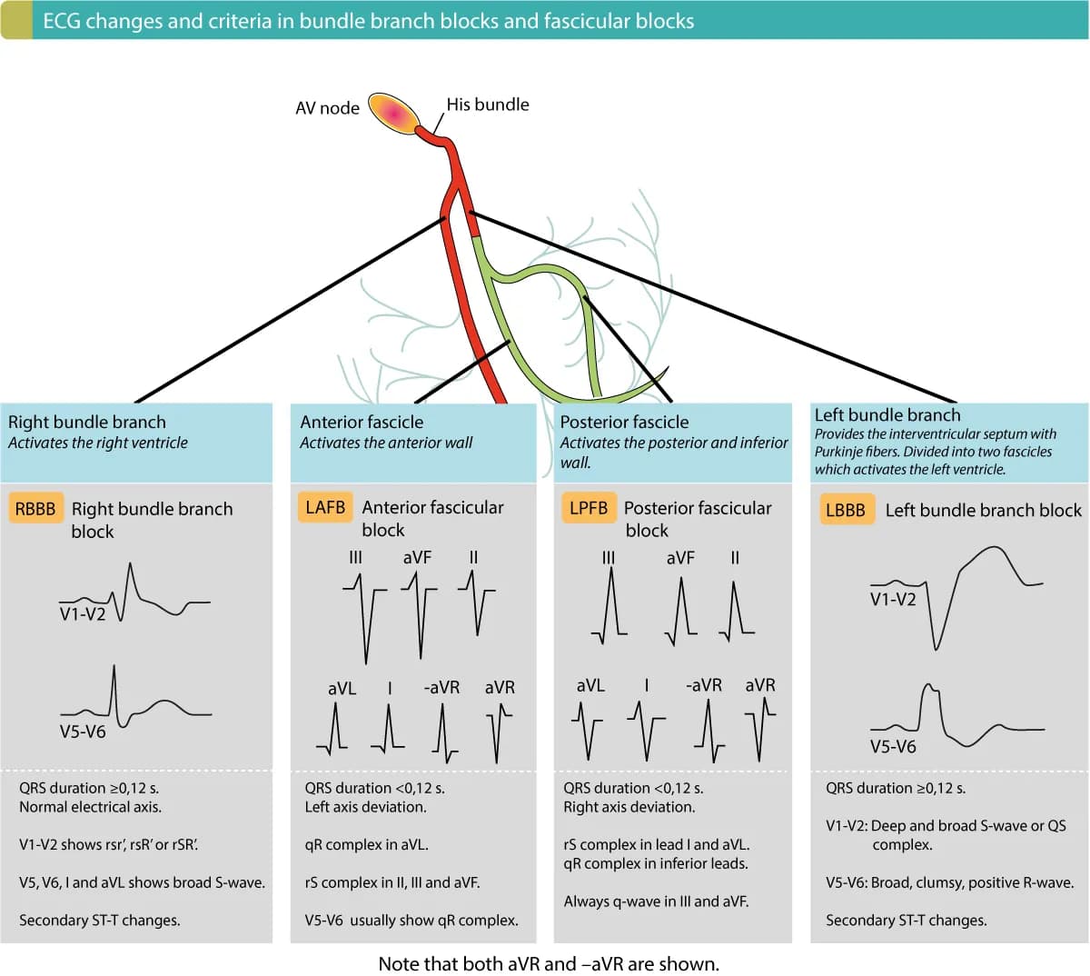 Figure 3. Overview of criteria and ECG changes in bundle branch blocks and fascicular blocks. All these intraventricular conduction delays are common and therefore important to recognize.