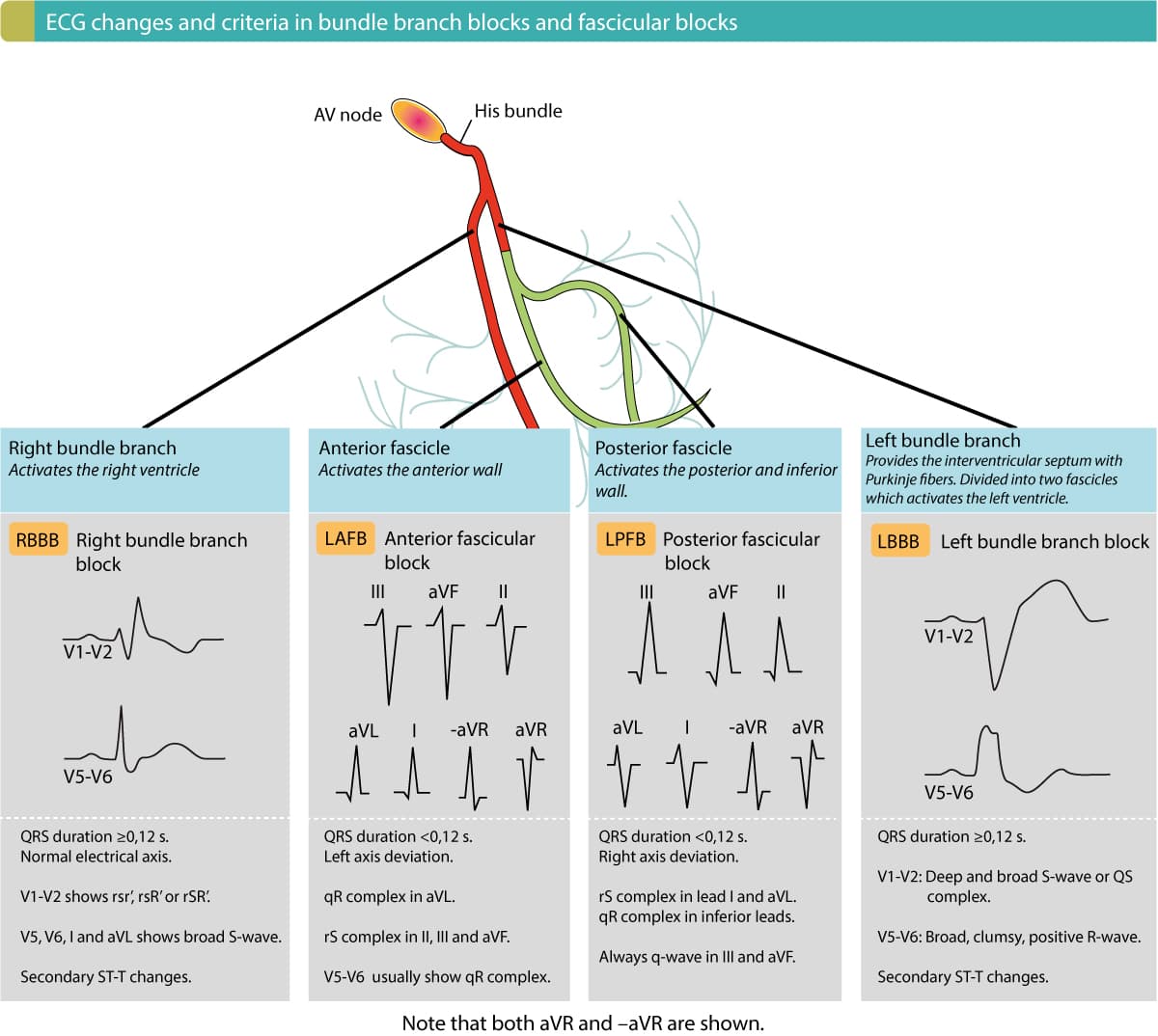 Figure 3. Overview of criteria and ECG changes in bundle branch blocks and fascicular blocks. All these intraventricular conduction delays are common and therefore important to recognize.