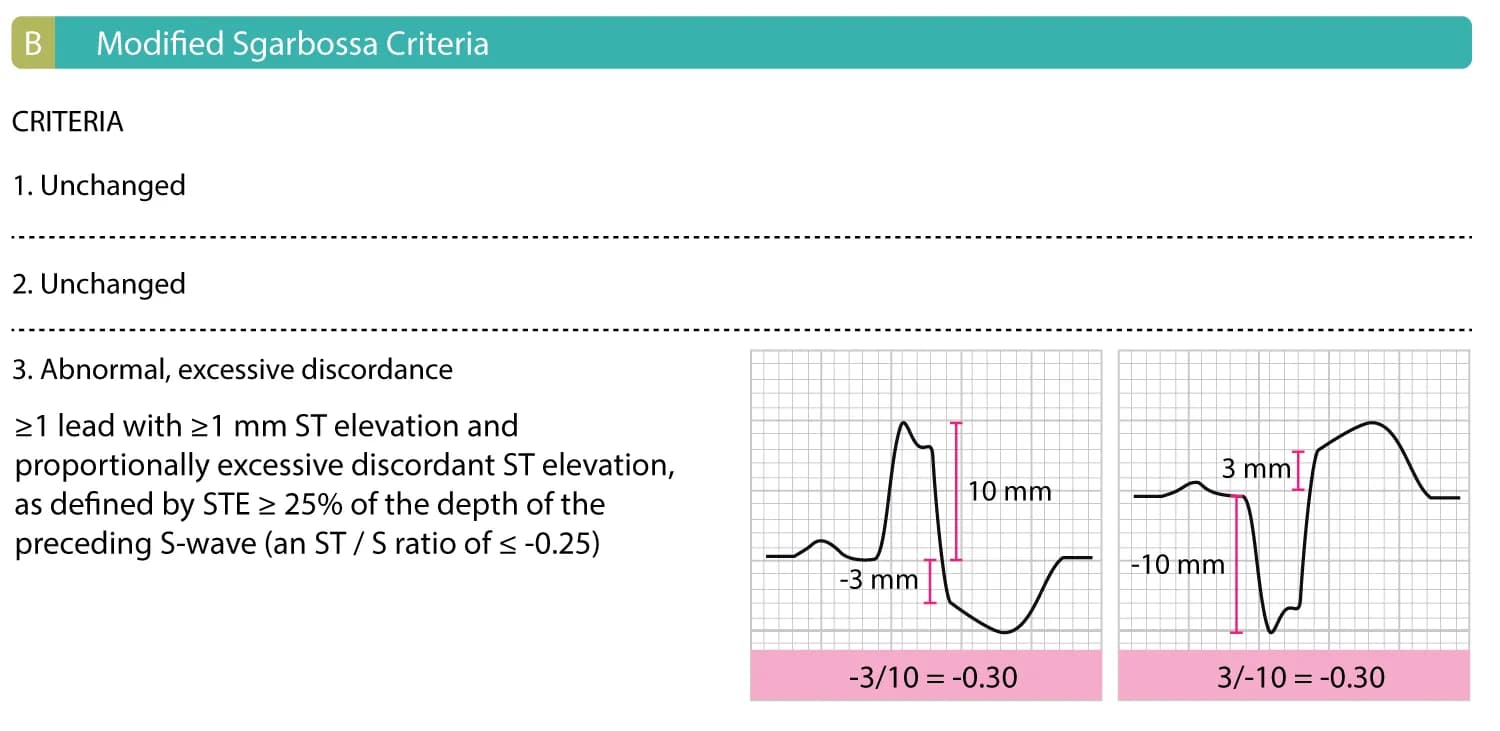 Figure 1B: Criteria 1 and 2 of the original Sgarbossa criteria are unchanged. The R or S wave, whichever is most prominent, and ST segments (relative to the PR segment), is measured to the nearest 0.5 mm. The ST/S ratio is calculated for each lead that has both discordant ST deviation ≥1 mm.