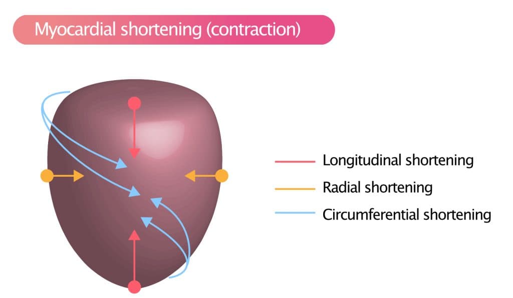 Figure 3. Myocardial contraction (shortening) occurs in three directions: longitudinally, radially and circumferentially.