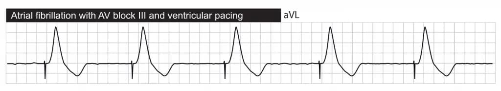 Atrial fibrillation with third-degree AV block, with ventricular pacing.