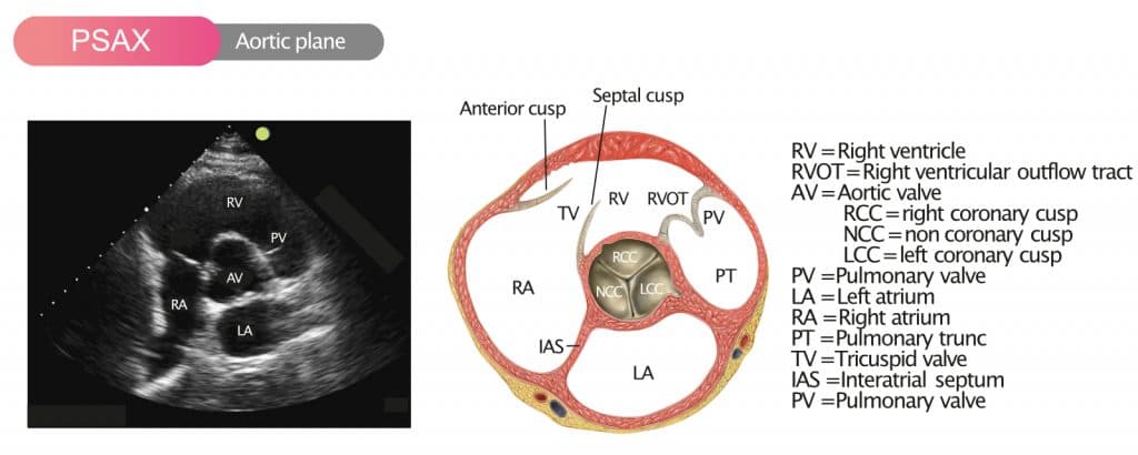 Figure 7. Parasternal short axis view (PSAX) in the aortic plane.