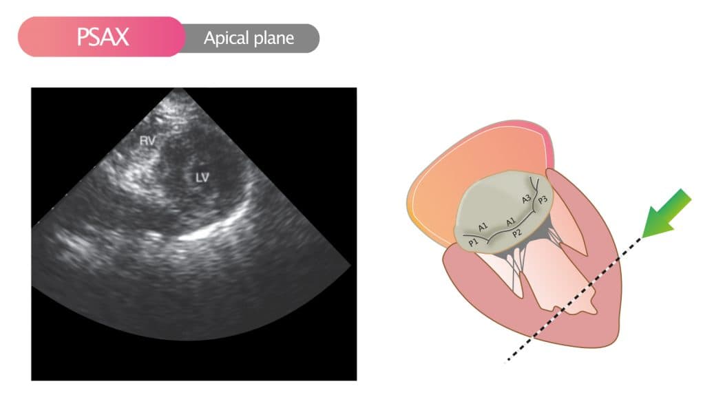 Figure 10. Parasternal short axis view (PSAX) in the apical plane.