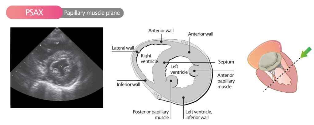 Figure 9. Parasternal short axis view (PSAX) in the papillary muscle plane.