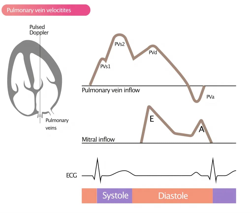 Figure 5. Measurement of pulmonary vein velocities with pulsed Doppler.