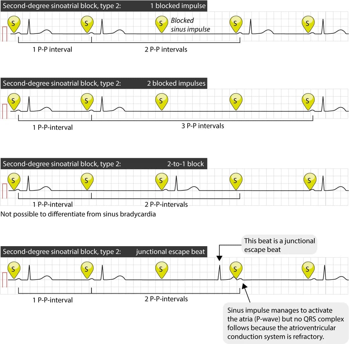 Figure 3. Several cases of type 2 second-degree sinoatrial block.