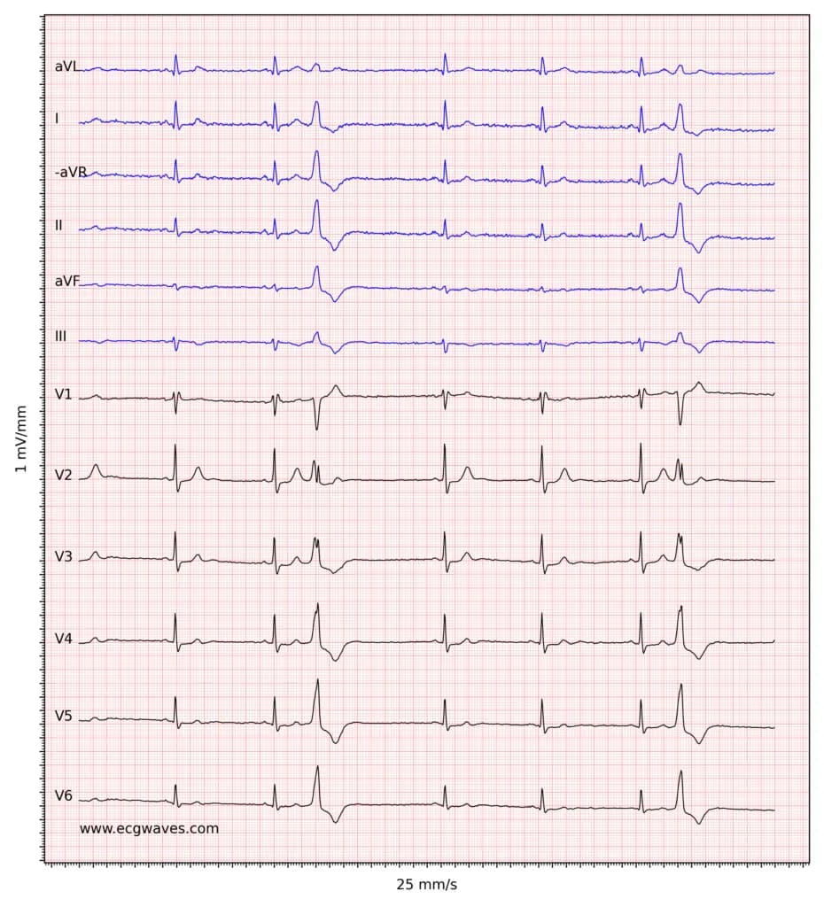 Figure 2. Sinus bradycardia, premature ventricular contractions, incomplete right bundle branch block and ST-segment depressions in V2-V6.