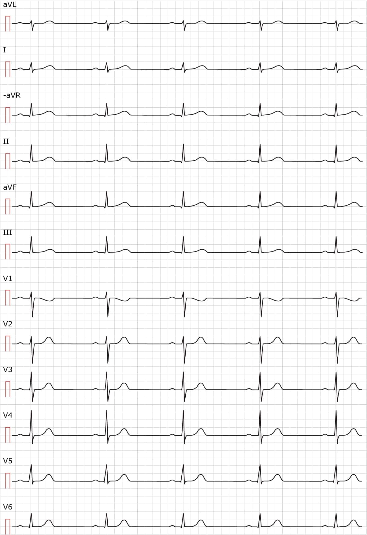 Figure 2. Sinus rhythm. Paper speed 50 mm/s.