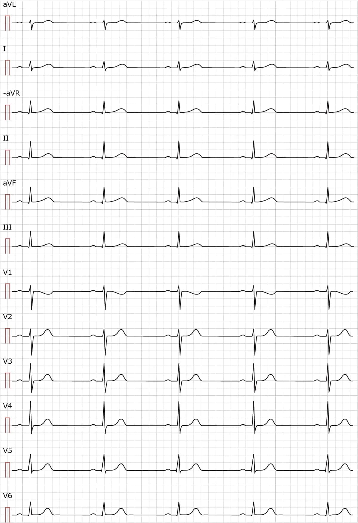 Figure 2. Sinus rhythm. Paper speed 50 mm/s.